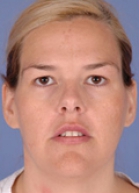 Blepharoplasty Before & After Patient #261