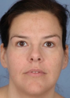 Blepharoplasty Before & After Patient #261