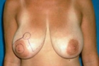 Breast Reduction Before & After Patient #528