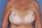 Breast Reconstruction Before & After Patient #506