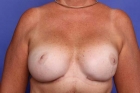 Breast Reconstruction Before & After Patient #506