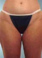 Liposuction Before & After Patient #176