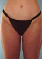 Liposuction Before & After Patient #176