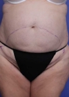 Liposuction Before & After Patient #182