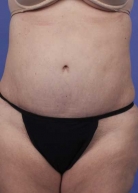 Liposuction Before & After Patient #182