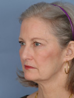 Facelift Before & After Patient #334