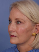 Facelift Before & After Patient #334