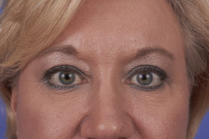 Blepharoplasty Before & After Patient #274