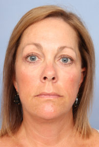 Facelift Before & After Patient #327