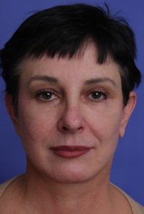Facelift Before & After Patient #322