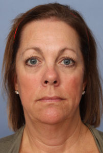 Facelift Before & After Patient #327
