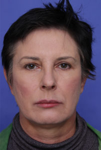 Facelift Before & After Patient #322