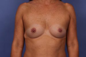 Breast Augmentation Before & After Patient #475
