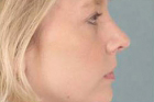 Rhinoplasty Before & After Patient #345