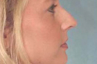 Rhinoplasty Before & After Patient #345