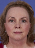 Brow Lift Before & After Patient #284
