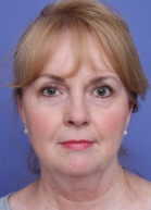 Brow Lift Before & After Patient #284