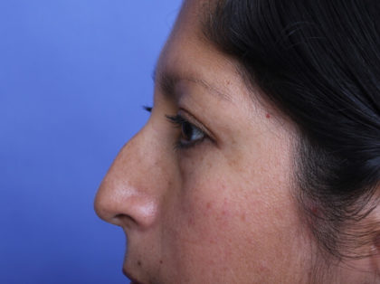 Rhinoplasty Before & After Patient #2297