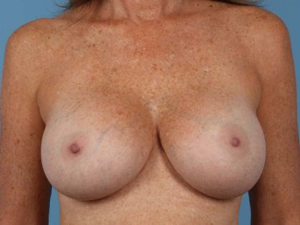 Breast Augmentation Before & After Patient #2910