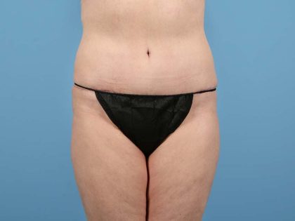 Tummy Tuck Before & After Patient #2906