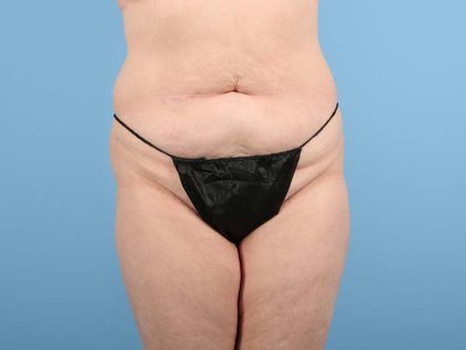Tummy Tuck Before & After Patient #2906