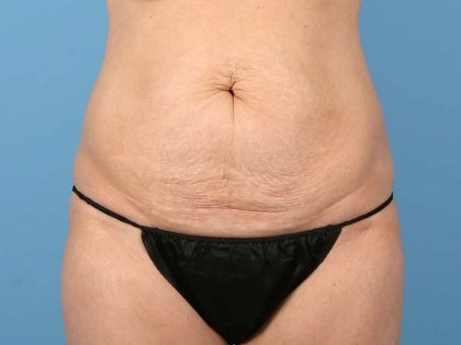 Tummy Tuck Before & After Patient #2905