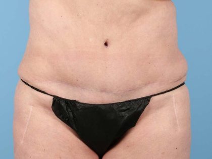 Liposuction Before & After Patient #2903