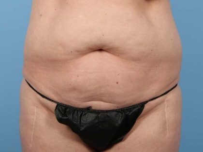 Liposuction Before & After Patient #2903